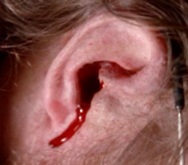 11-ear-bleeding.jpg
